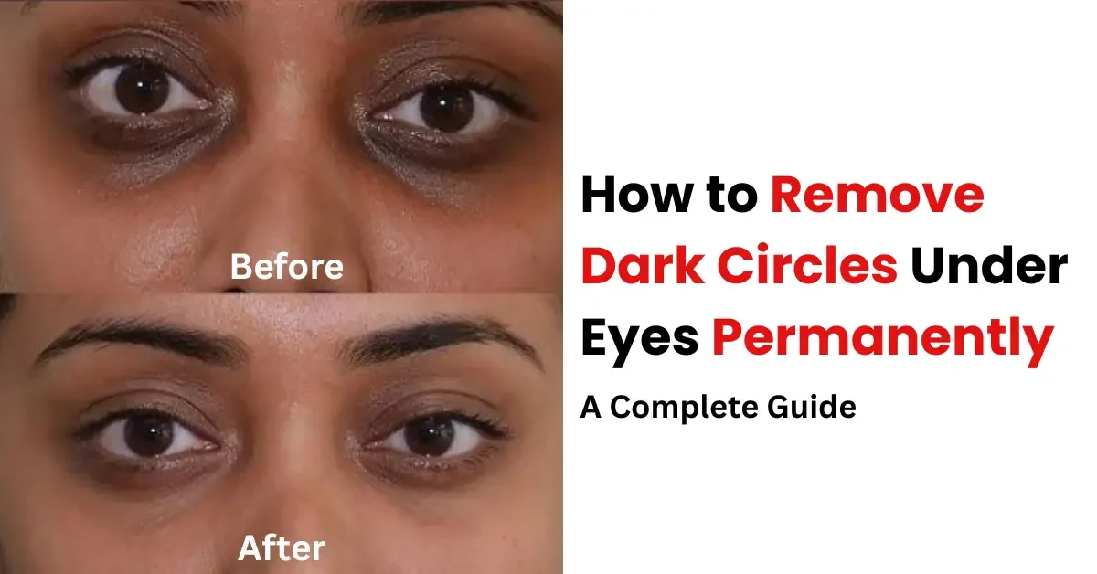 How to Remove Dark Circles Under Eyes Permanently